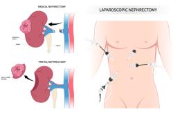 肾盂肿瘤存活率高吗