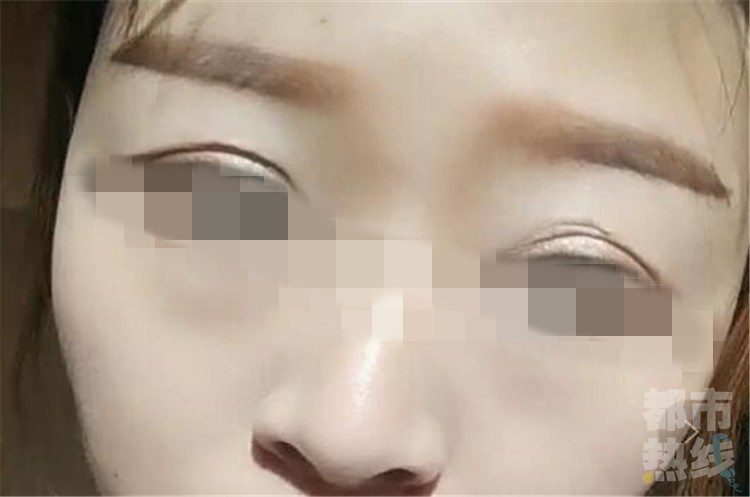 西安一女子割双眼皮割成了三眼皮 医院竟然怪患者眼皮松！